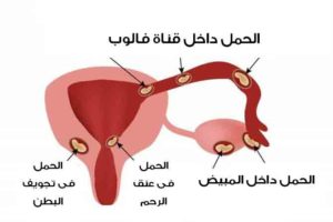 إفرازات الحمل خارج الرحم